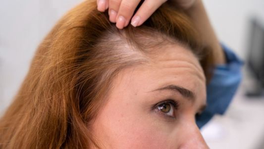 Alopecia areata: pesquisa aponta que impacto mental é o pior da doença