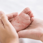 Uberlândia investiga nove casos suspeitos de sarampo em crianças de um ano