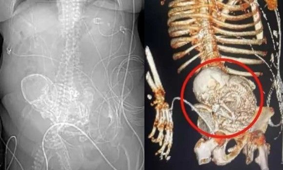 'Grávida' há mais de 50 anos, idosa descobre feto calcificado em abdômen