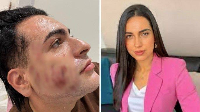 Peeling de fenol: PC conclui investigação sobre morte de empresário e indicia influenciadora por homicídio