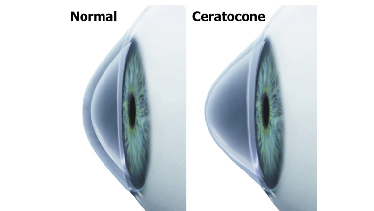 Ceratocone: campanha Junho Violeta alerta para detecção precoce da doença ocular rara