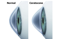 Hábito de coçar os olhos pode causar ceratocone, alerta oftalmologista