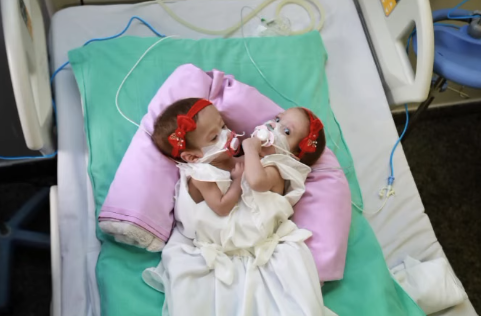Morrem siamesas que nasceram unidas pelo tórax e abdômem em Goiânia