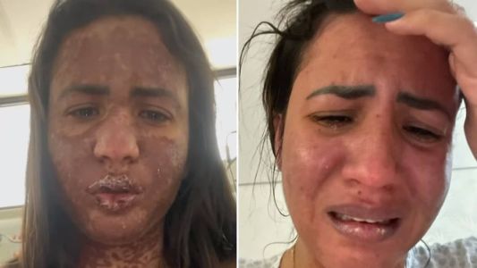 Caroline Aguiar possui Stevens-Johnson, doença que provoca lesões na pele