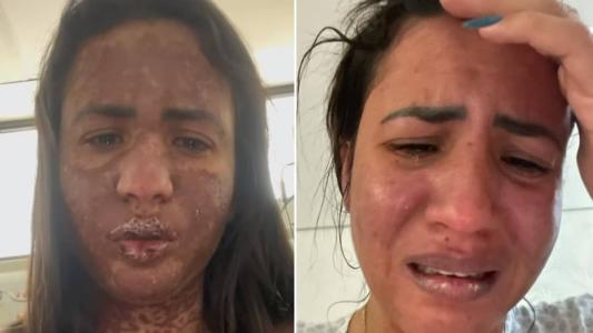 Caroline Aguiar possui Stevens-Johnson, doença que provoca lesões na pele