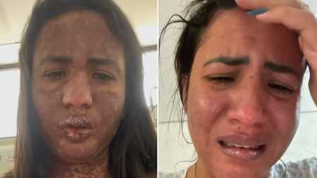 Caroline Aguiar possui Stevens-Johnson, doença que provoca lesões na pele