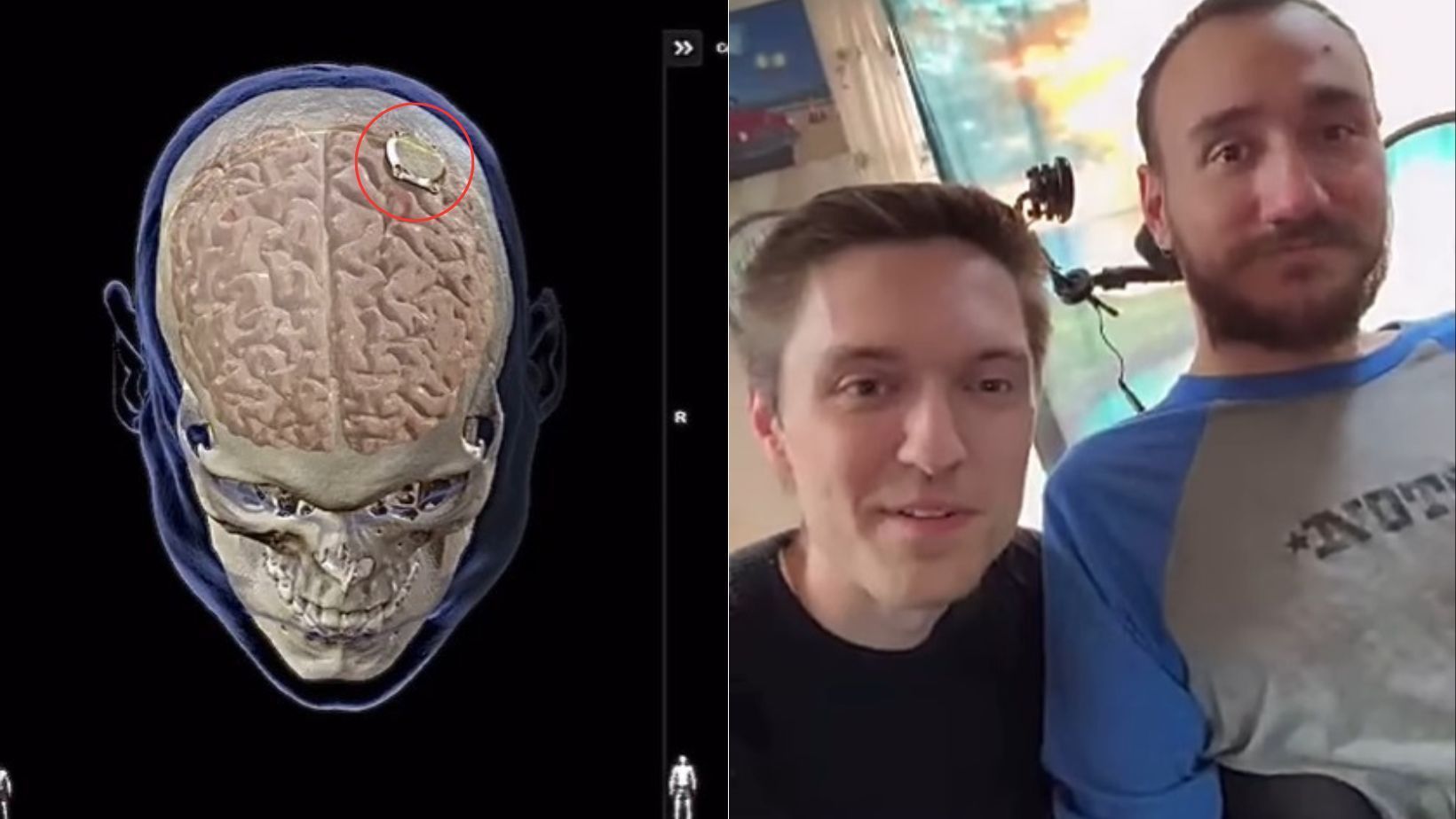 Vídeo: paciente que recebeu o primeiro implante da Neuralink mostra como chip cerebral funciona