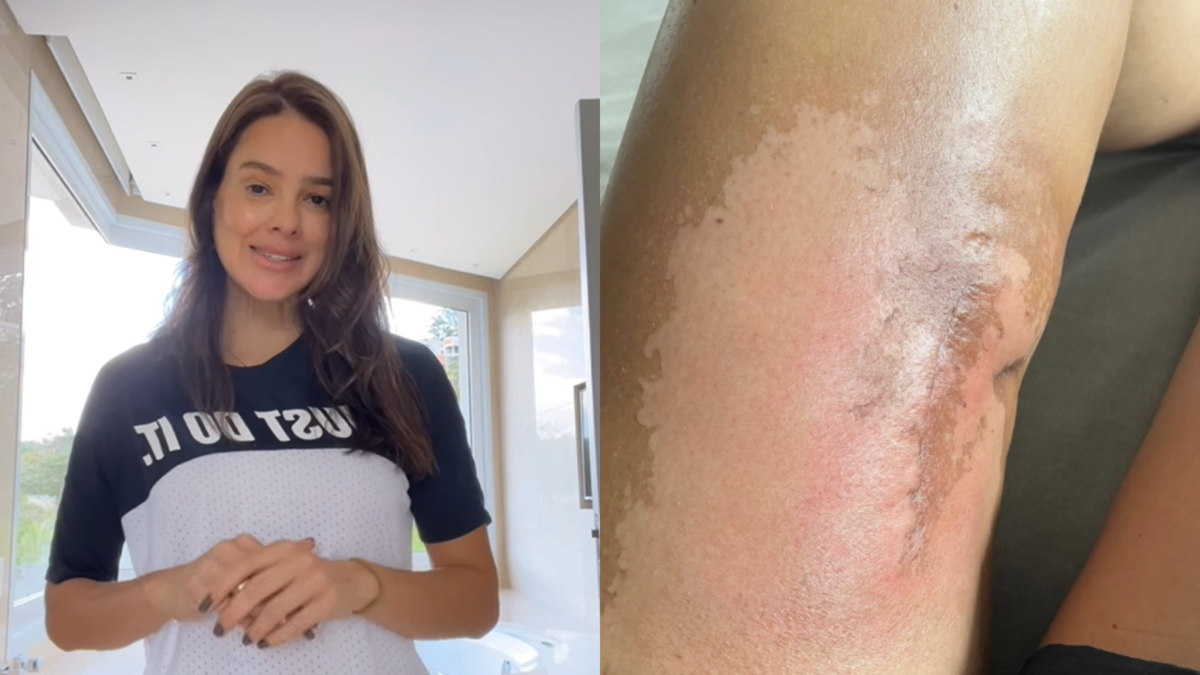 Vera Viel mostra cicatrização da perna após retirada de tumor: ‘O processo’