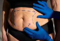 Fibrose, necrose e trombose: especialista explica riscos da cirurgia plástica