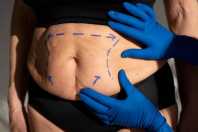 Fibrose, necrose e trombose: especialista explica riscos da cirurgia plástica