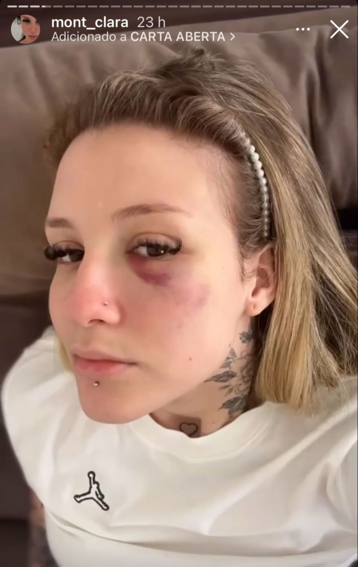 Postagem de Clara Monteiro, em vídeo que mostra hematomas