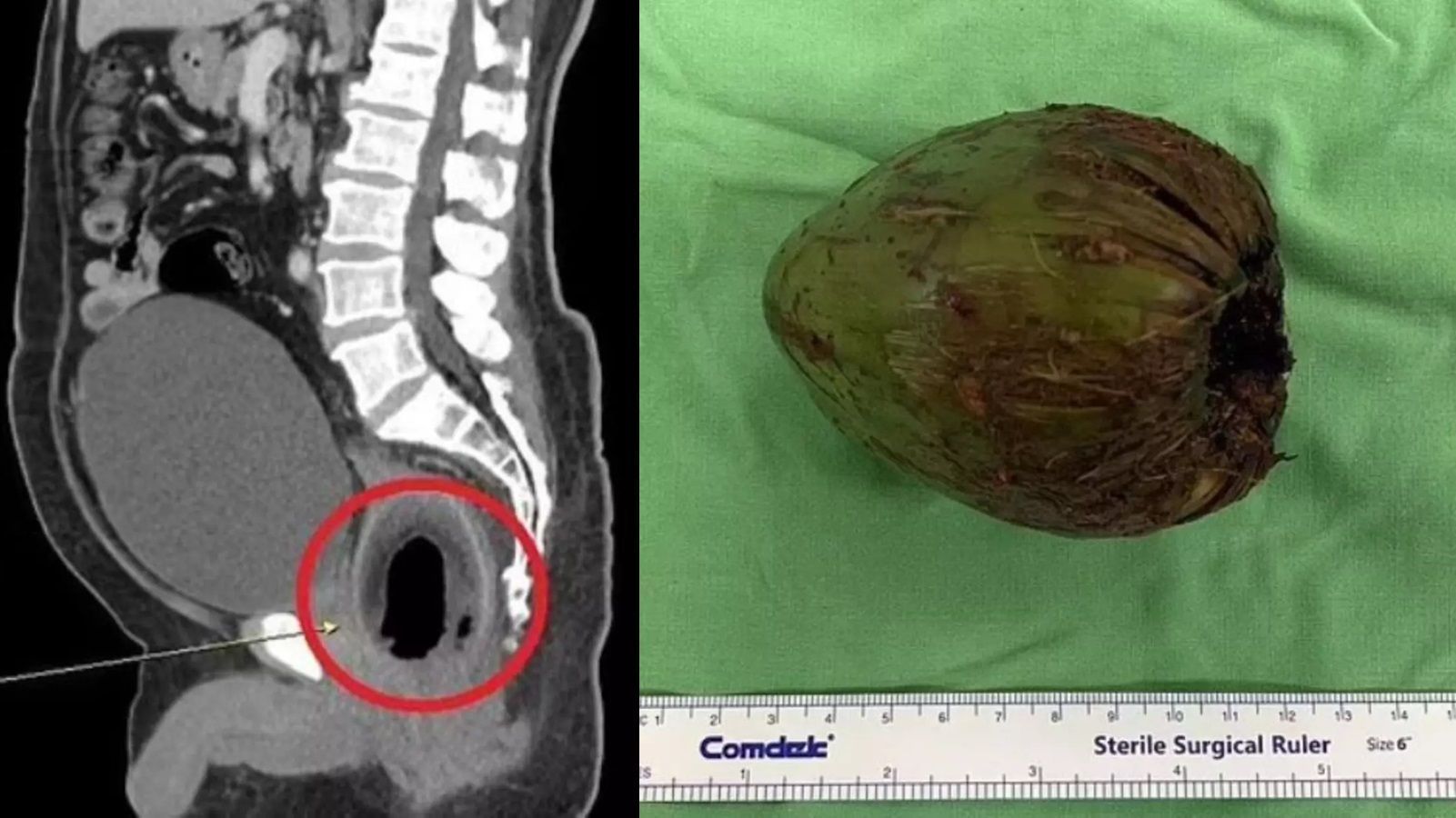 Homem passa por cirurgia para retirada de coco de 9 centímetros do ânus; entenda