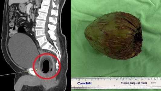 Foto mostra raio-x de paciente e coco retirado do ânus dele