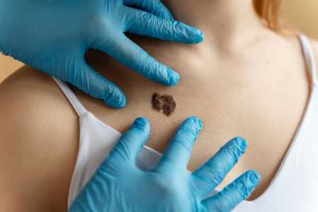 A regra do ABCDE é apenas um guia inicial, a confirmação diagnóstica de um melanoma só pode ser feita por um médico, geralmente um dermatologista