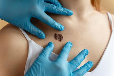 A regra do ABCDE é apenas um guia inicial, a confirmação diagnóstica de um melanoma só pode ser feita por um médico, geralmente um dermatologista