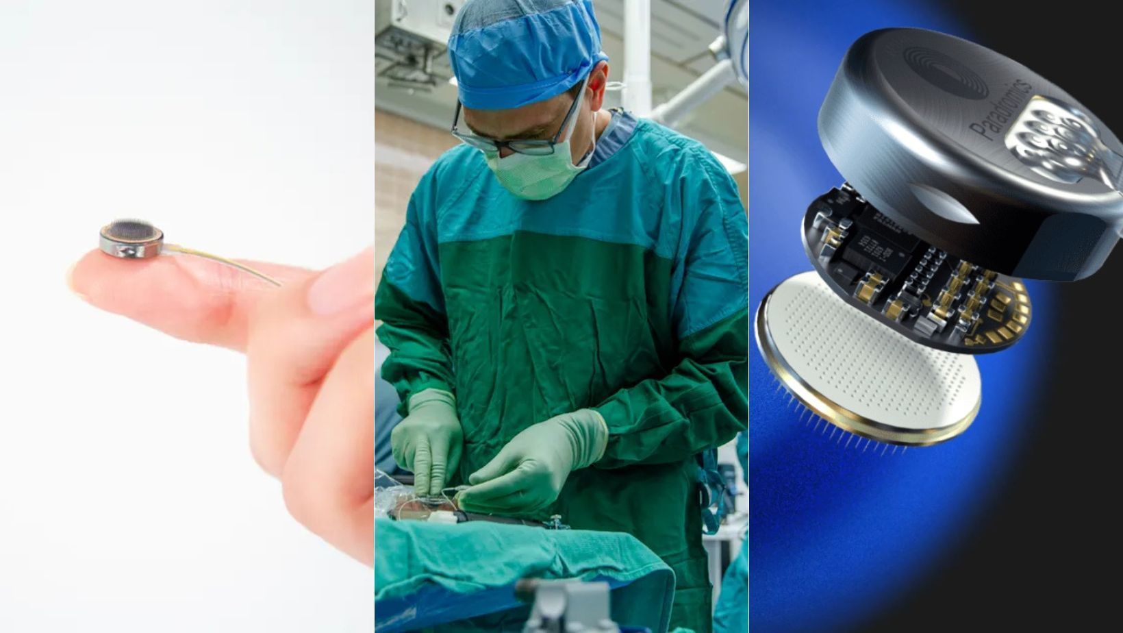 Concorrente da Neuralink, empresa faz o 1° implante de chip cerebral em humano; confira
