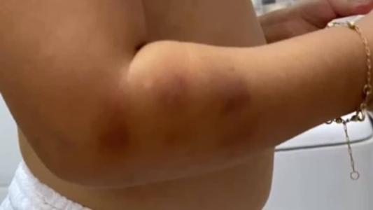 Mãe contou que criança não dormiu no dia em que apareceu com marcas pelo corpo