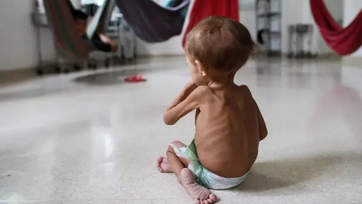 Morre criança yanomami de 1 ano internada com quadro de desnutrição grave e desidratação