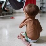 Morre criança yanomami de 1 ano internada com quadro de desnutrição grave e desidratação