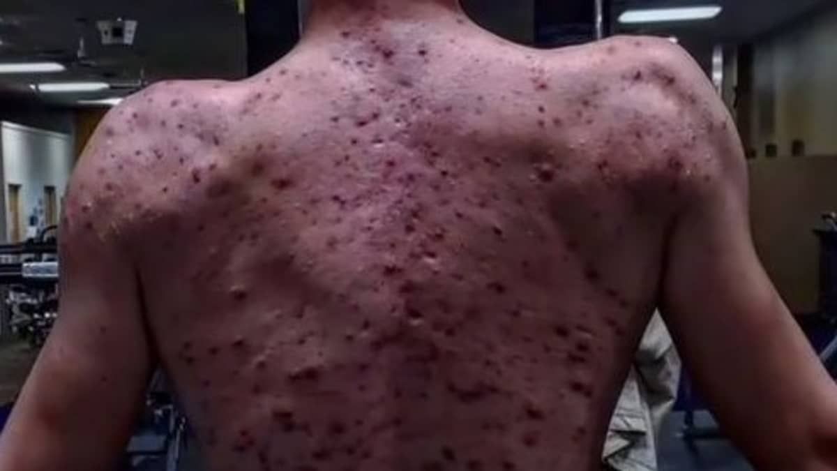 Jovem tem forte reação após tomar anabolizantes: 'valeu a pena'