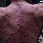 Jovem tem forte reação após tomar anabolizantes: 'valeu a pena'