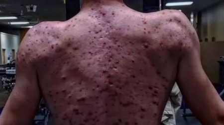 O jovem afirma que vai continuar usando os anabolizantes
