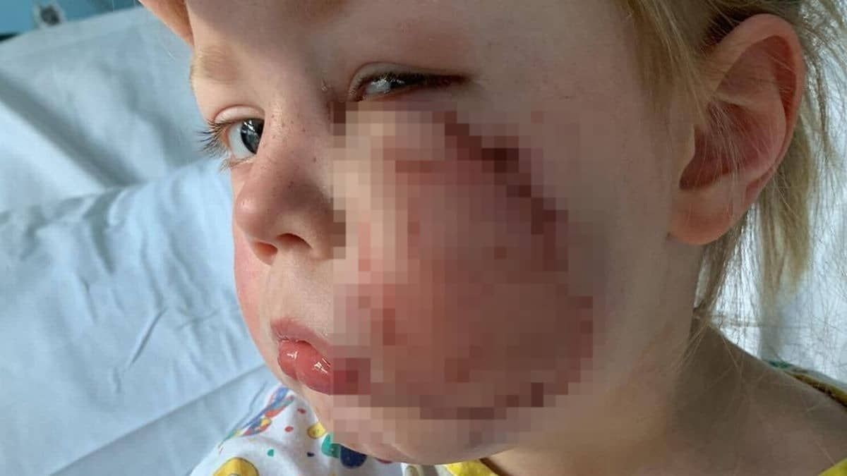 Menina de 4 anos é atacada por buldogue e leva 40 pontos no rosto