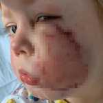 Menina de 4 anos é atacada por buldogue e leva 40 pontos no rosto