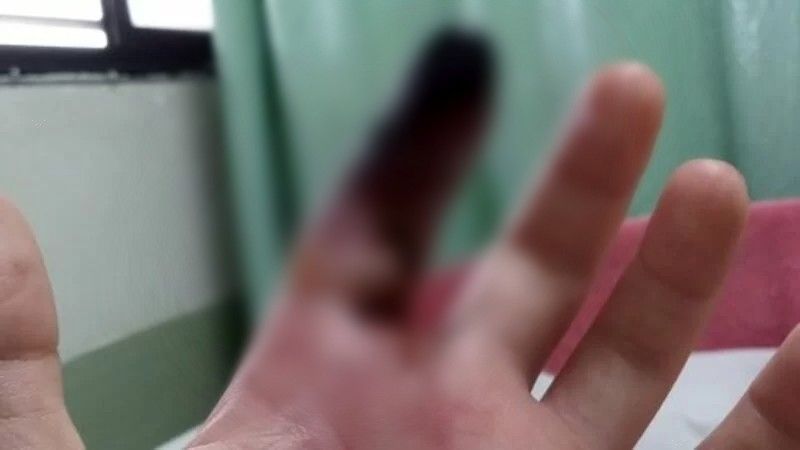 Homem precisará amputar dedo após ser picado por aranha em SP; ele alega negligência médica