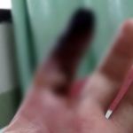 Homem precisará amputar dedo após ser picado por aranha em SP; ele alega negligência médica