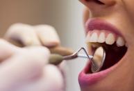 Nem bicarbonato de sódio nem vinagre: qual o segredo para remover o tártaro dos dentes