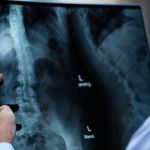 Artrose na coluna: entenda doença sem cura que causa dores intensas
