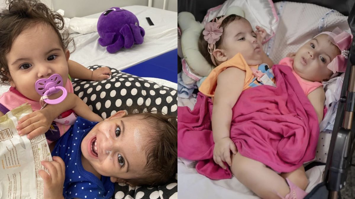 Gêmeas siamesas passam por cirurgia de separação neste sábado (10) em Goiás