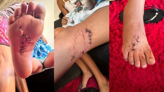 Ferimentos no pé e perna da criança atacada por cachorro