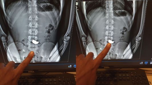 Raio-x mostra corrente de ouro no esôfago de assalante