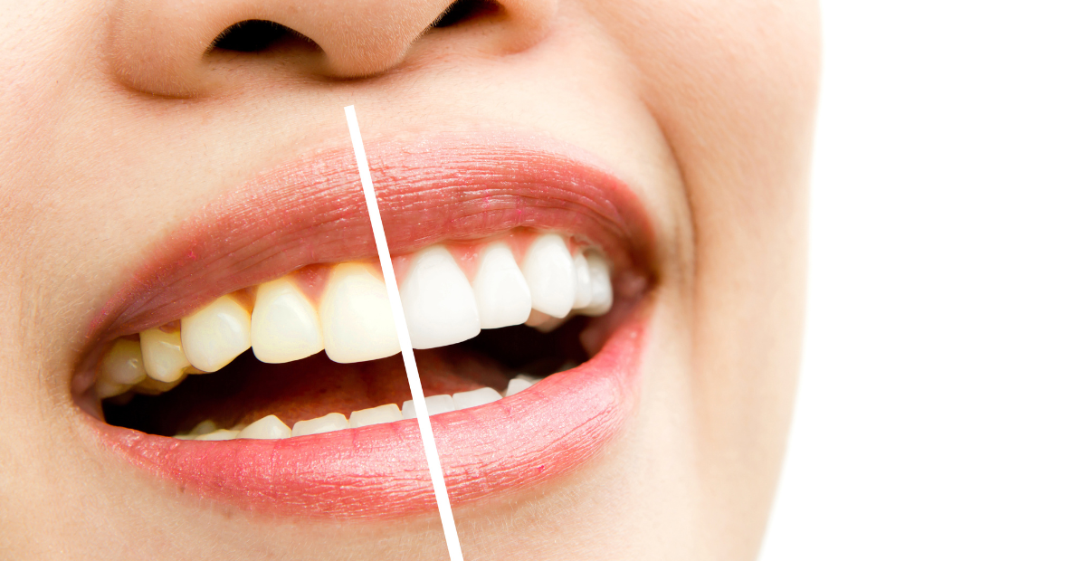 Como eliminar o tártaro dos dentes em casa: o truque dos dentistas