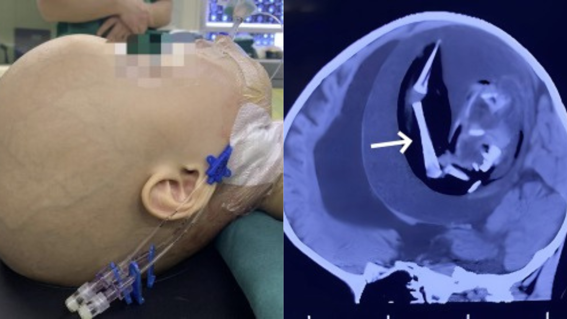 Criança chinesa nasce com 'gêmeo parasita' alojado no crânio