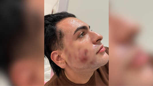 Homem que morreu em clínica de SP pagou R$ 4.500 por ‘peeling de fenol’ | CNN Brasil