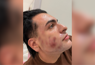 Peeling de fenol: médico explica nova medida do CFM que autoriza substância