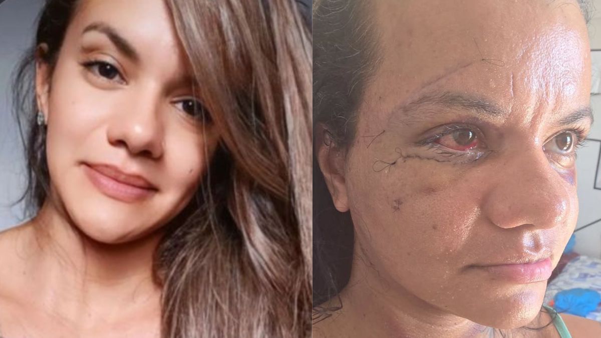 Mulher desfigurada ao levar 61 socos do namorado mostra rosto após reconstrução facial