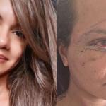 Mulher desfigurada ao levar 61 socos do namorado mostra rosto após reconstrução facial