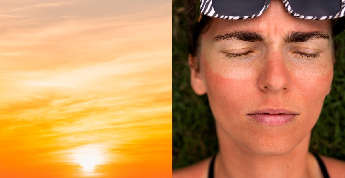 Saiba como minimizar os efeitos das queimaduras do sol