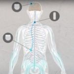 Dispositivo ajuda tetraplégicos a recuperar movimentos nas mãos e nos braços com estímulos elétricos