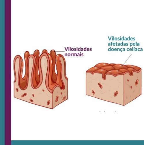 Fabiana de Lemos | Vitaminas B12, D e ferro baixos? Pensar em distúrbio relacionado ao glúten
