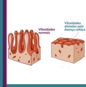 Doença celíaca 'irrita' o intestino delgado