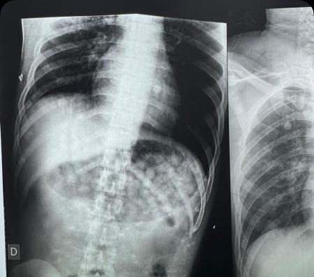 RAIO X de jovem que ingeriu capsulas de droga em Montes Claros