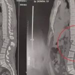 Homem atingido por aparelho de musculação passa por cirurgia e já consegue sentar