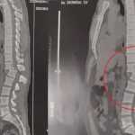 Homem atingido por aparelho de musculação passa por cirurgia e já consegue sentar