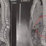 Homem atingido por aparelho de musculação passa por cirurgia e já consegue sentar