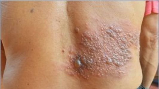 A Herpes-Zóster é uma doença causada pelo vírus Varicela-Zóster (VVZ), o mesmo que causa a Catapora